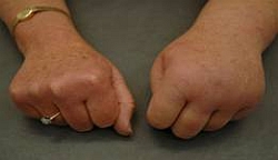  Manuele lymfedrainage voor lymfoedeem in de linker hand 